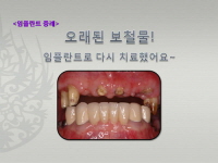 오래된 보철물!…