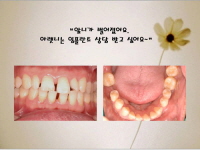 앞니가 벌어졌…