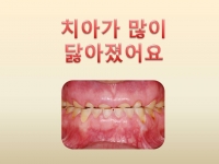 치아가 많이 닿…