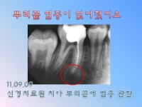 뿌리 끝에 염증…