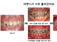 아랫니가 너무 …