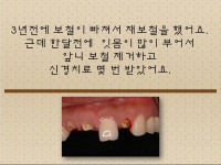 앞니 신경치료…