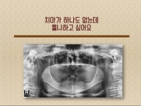 무치악 임플란…