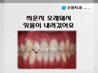 씌운지 오래돼…