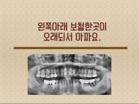 왼쪽아래 보철…