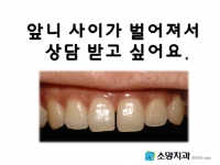 앞니 사이가 벌…