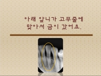 고무줄에 맞아…