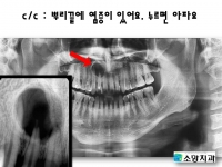 보철한 뿌리끝…