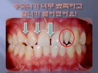 송곳니가 너무 …