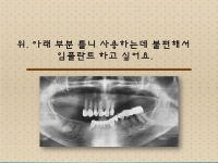 부분 틀니 사용…