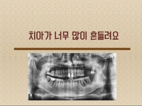 치아가 너무 많…