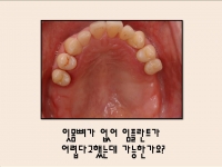 잇몸뼈가 없어 …