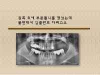 부분틀니를 했…