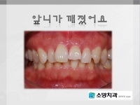앞니가 깨졌어…
