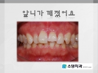 앞니가 깨졌어…