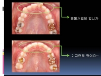 앞니가 삐뚤삐…