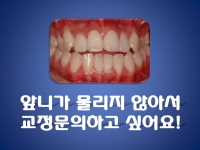 앞니가 물리지 …