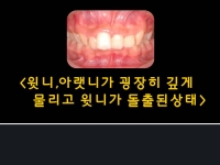 치아가 깊게 물…