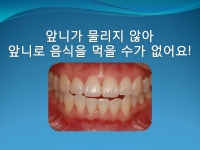 Open Bite