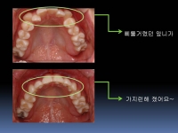 앞니가 삐뚤어…