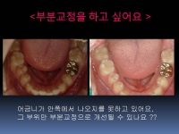 어금니 부분교…