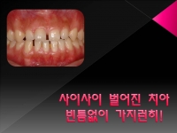 벌어진 치아는!