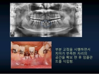 선천적인 치아…