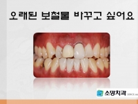 오래된 보철물 …