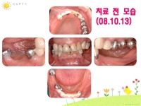 심미탄력의치-V…