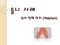심미탄력의치-V…