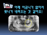 내려온 윗니 없…