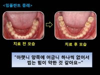 양쪽에 어금니…