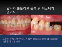 흔들리는 앞니…