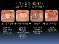 보철기둥 Post …
