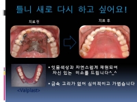 심미탄력의치 …