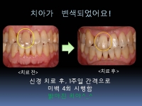 신경치료후 변…